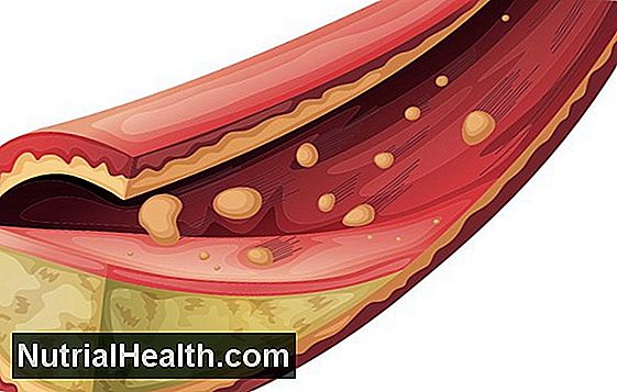 Kann Hdl Clear Arterie Plaque Erhöhen?